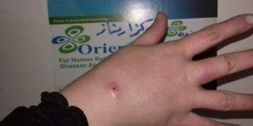 حبة اللشمانيا (حبة حلب) تعاود الانتشار في محافظة حلب: خطر صحي يتجاهله العالم