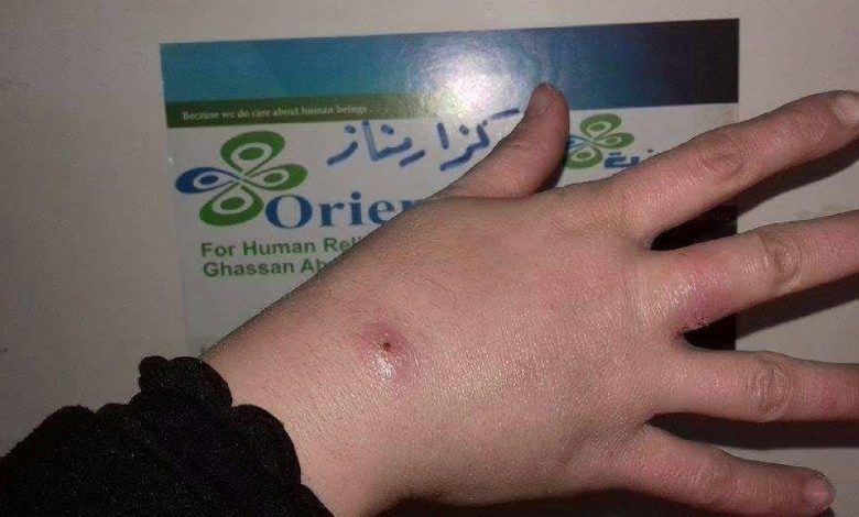 حبة اللشمانيا (حبة حلب) تعاود الانتشار في محافظة حلب: خطر صحي يتجاهله العالم